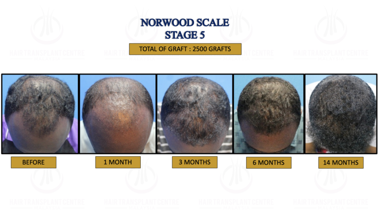 10. NORWOOD SCALE STAGE 5 5