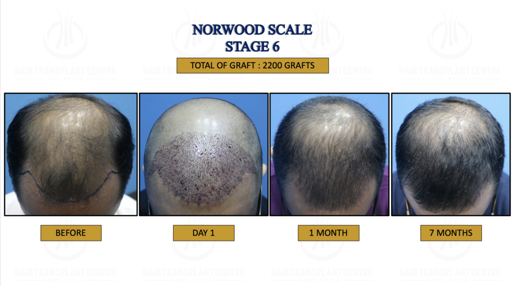 14. NORWOOD SCALE STAGE 6
