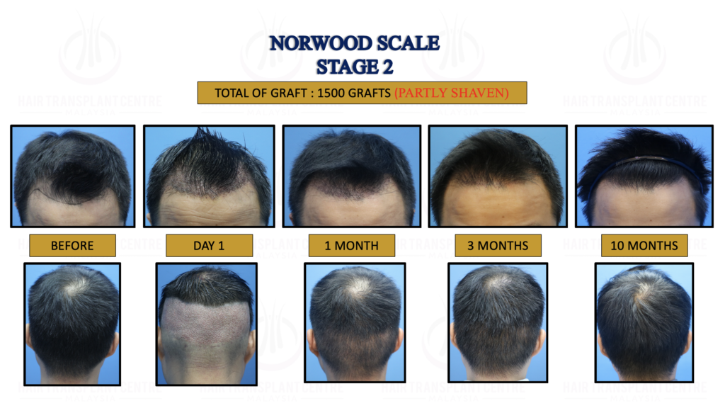 2. NORWOOD SCALE STAGE 2