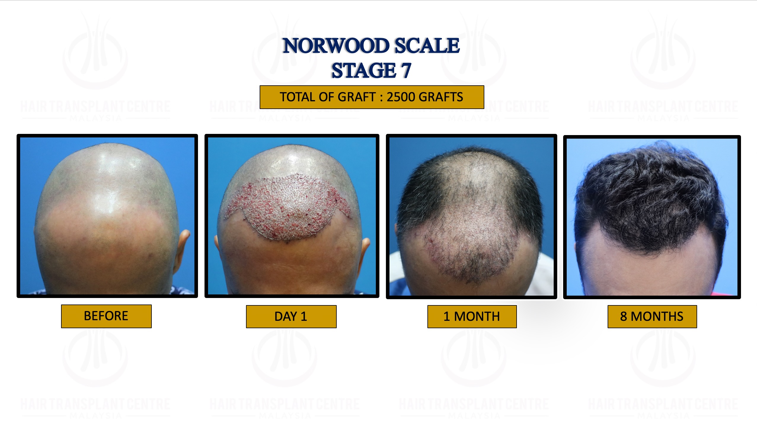 20. NORWOOD SCALE STAGE 7.