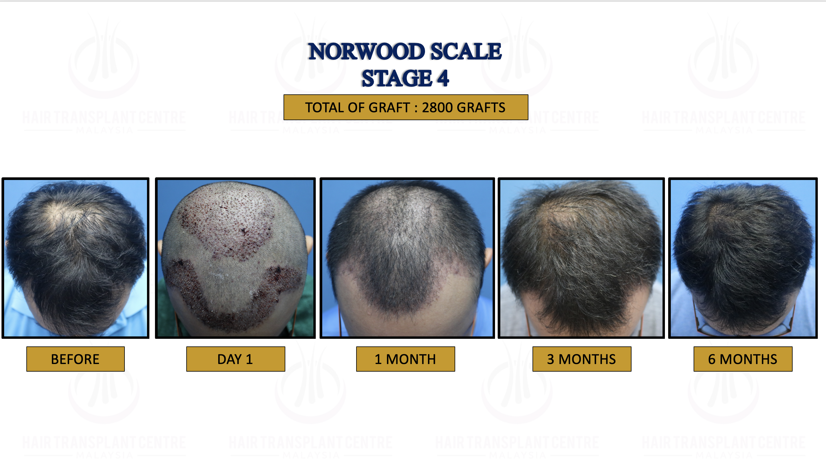 5. NORWOOD SCALE STAGE 4