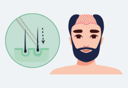 FUE Malaysia - Hair Transplant - Procedure Step 3